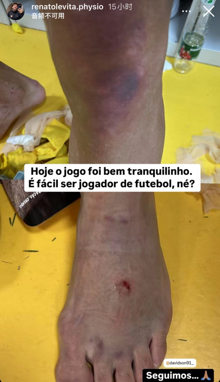 西海岸理療師曬戴維森腿部傷勢照：當足球運動員很容易，對吧？