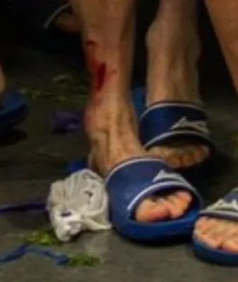 紅牌也不冤！被帕利尼亞蹬踏的波鴻球員，賽后小腿創(chuàng)口依然明顯